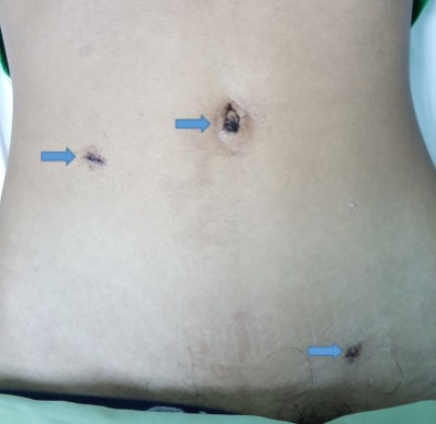 腹腔镜内环缝合疝修补(PIRS)手术后（蓝色箭头指着手术伤口）