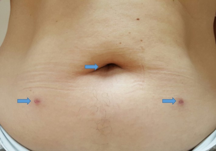 腹腔腹膜前疝修补(TAPP)手术后（蓝色箭头指着手术伤口）