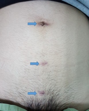 腹腔外腹膜前疝修补(TEP)手术后（蓝色箭头指着手术伤口）